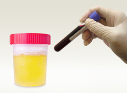 test tube filled with blood and urine sample in a cup