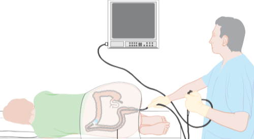 AI-assisted colonoscopy