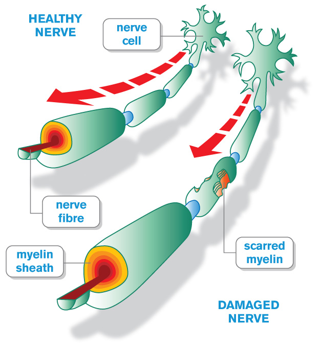 demylination