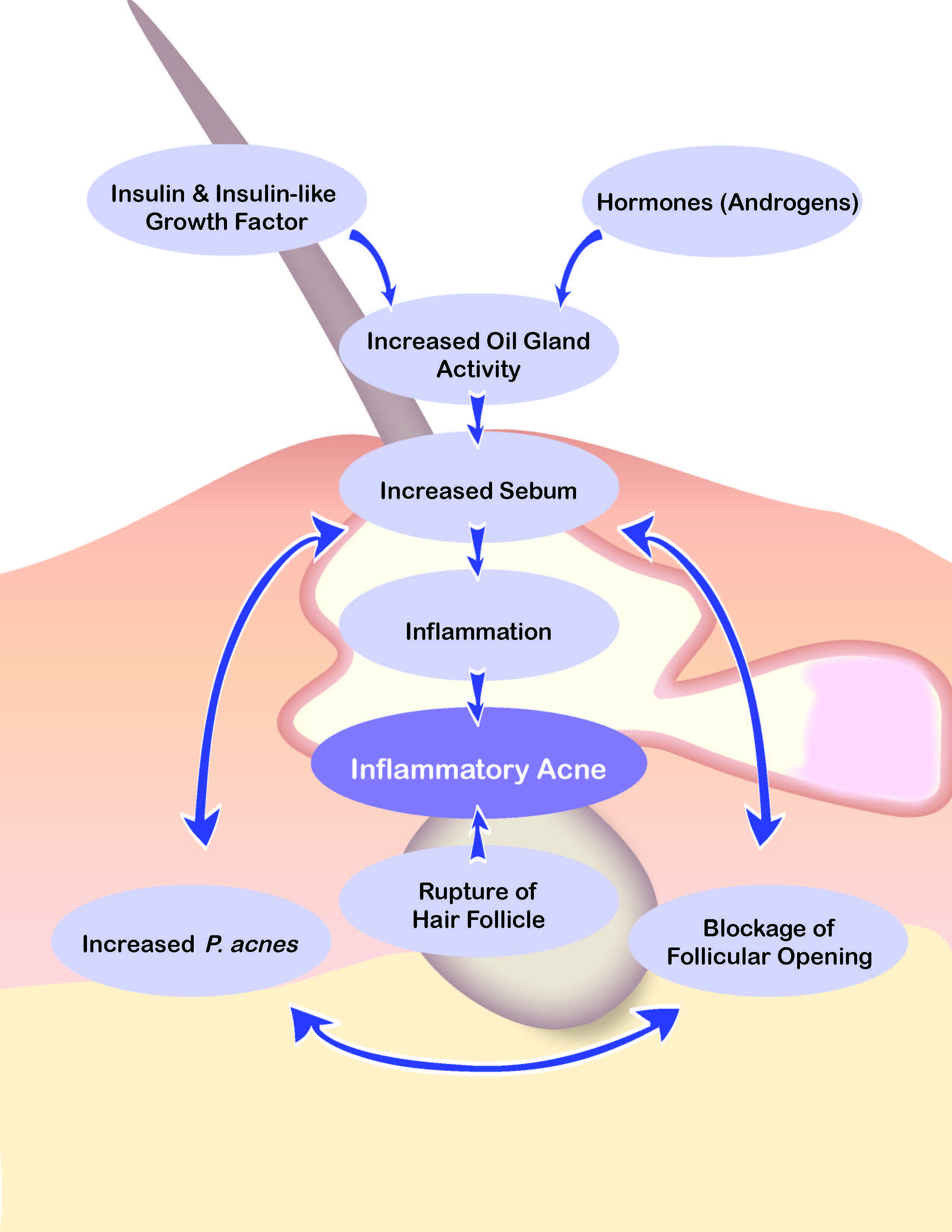 Graphic drawing of a hair folicle breaking through the skin with a cream-colored base under the hair folicle. Text balloons laid over the image explain the pathophysiology of acne. It starts with "Insulin and Insulin-like Growth Factor" in one balloon and "Hormones (Androgens)" in another balloon. Both have arrows that point to "Increased Oil Gland Activity." Then to "Increased Sebum, " then "Inflammation," and then "Inflammatory acne." There is another text balloon below the "Inflammatory Acne" balloon that reads "Rupture of Hair Follicle." There is an arrow that points from this balloon to "Inflammatory Acne." There is also a circular diagram going (clockwise) from balloon 1 "Blockage of Follicular Opening" to "Increased P. Acnes" to "Increases Sebum" with arrows pointing in both directions between the balloons.